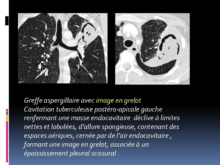 Greffe aspergillaire avec image en grelot Cavitation tuberculeuse postéro-apicale gauche renfermant une masse endocavitaire