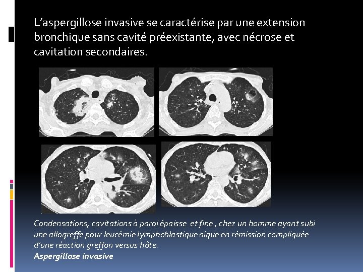 L’aspergillose invasive se caractérise par une extension bronchique sans cavité préexistante, avec nécrose et