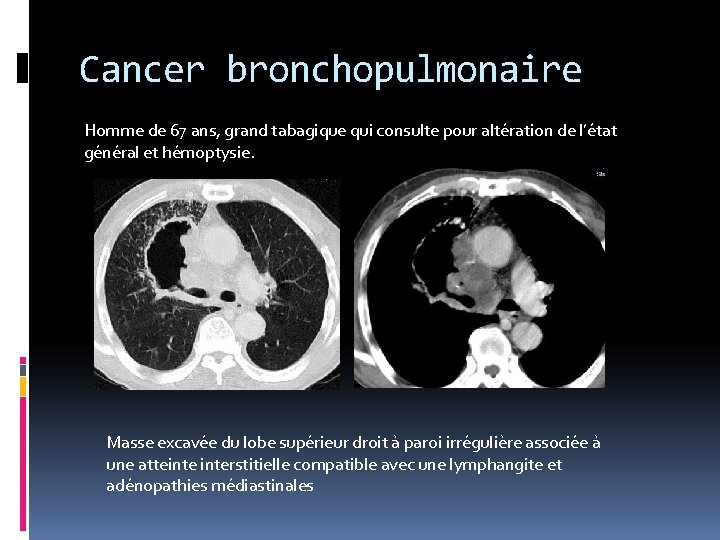 Cancer bronchopulmonaire Homme de 67 ans, grand tabagique qui consulte pour altération de l’état
