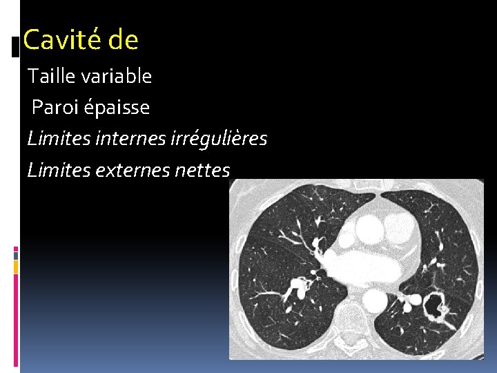 Cavité de Taille variable Paroi épaisse Limites internes irrégulières Limites externes nettes 