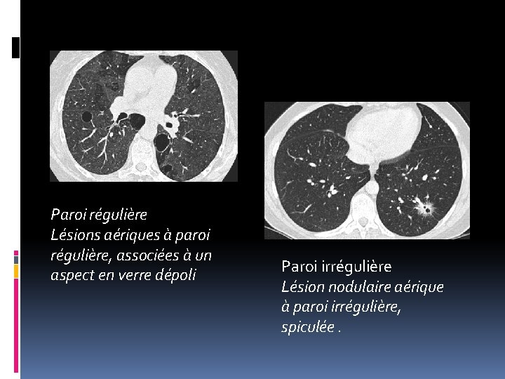 Paroi régulière Lésions aériques à paroi régulière, associées à un aspect en verre dépoli