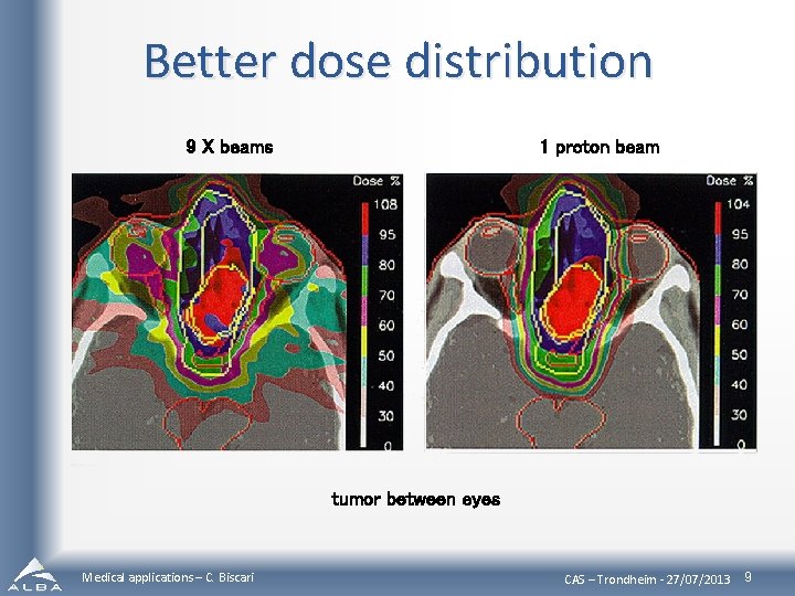 Better dose distribution 9 X beams 1 proton beam tumor between eyes Medical applications