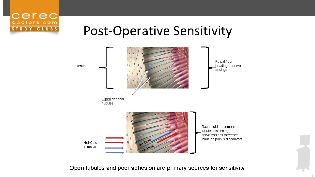 Post-Operative Sensitivity Pulpal floor Leading to nerve endings Dentin Open dentinal tubules Hot/Cold stimulus
