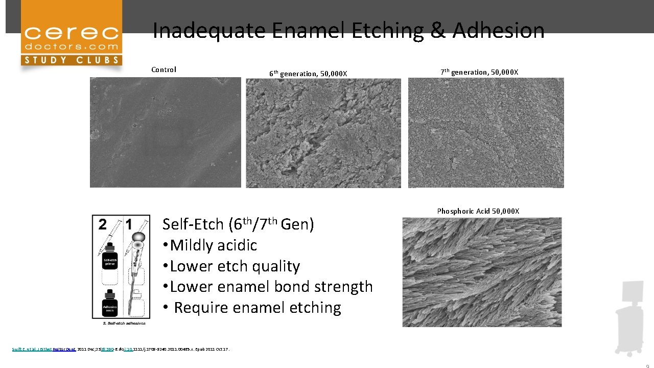 Inadequate Enamel Etching & Adhesion Control 6 th generation, 50, 000 X Self-Etch (6