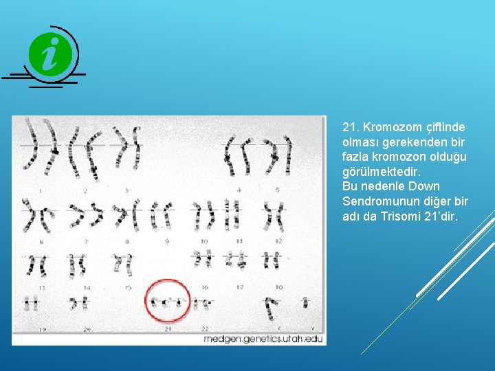 21. Kromozom çiftinde olması gerekenden bir fazla kromozon olduğu görülmektedir. Bu nedenle Down Sendromunun
