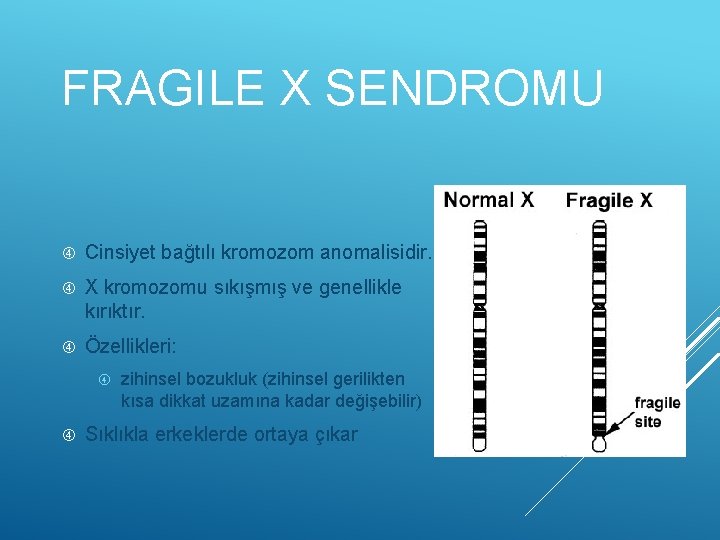 FRAGILE X SENDROMU Cinsiyet bağtılı kromozom anomalisidir. X kromozomu sıkışmış ve genellikle kırıktır. Özellikleri: