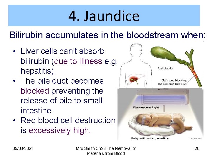 4. Jaundice Bilirubin accumulates in the bloodstream when: • Liver cells can’t absorb bilirubin