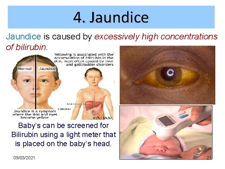 4. Jaundice is caused by excessively high concentrations of bilirubin. Baby’s can be screened