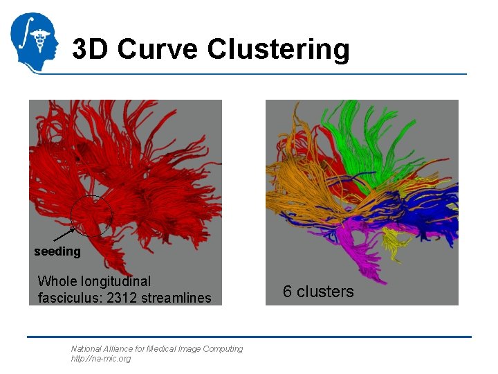 3 D Curve Clustering seeding Whole longitudinal fasciculus: 2312 streamlines National Alliance for Medical