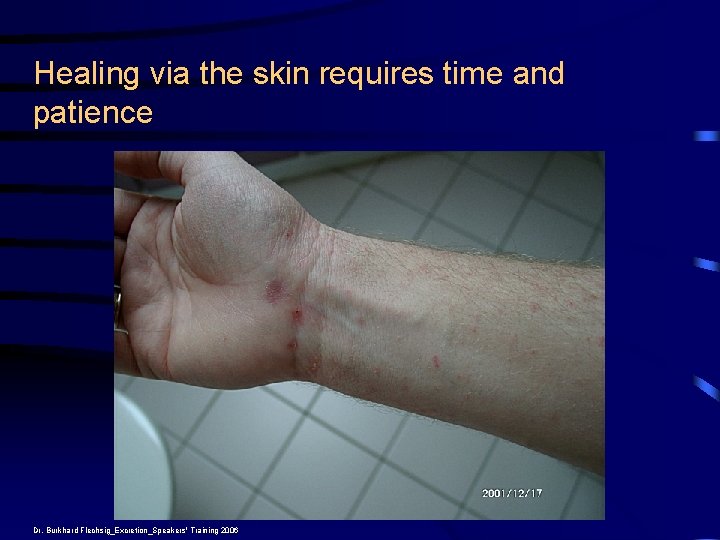 Healing via the skin requires time and patience Dr. Burkhard Flechsig_Excretion_Speakers' Training 2006 