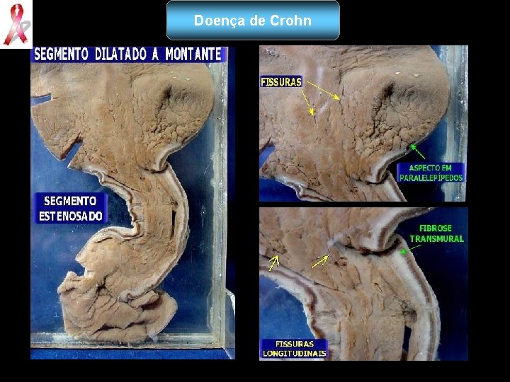 Doença de Crohn 