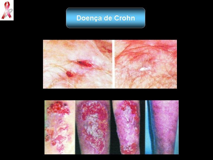 Doença de Crohn 