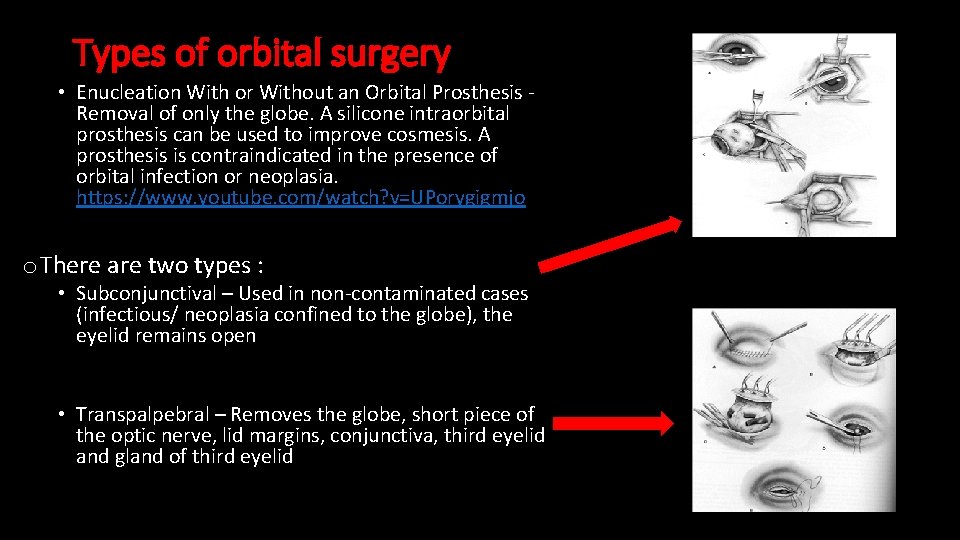 Types of orbital surgery • Enucleation With or Without an Orbital Prosthesis - Removal