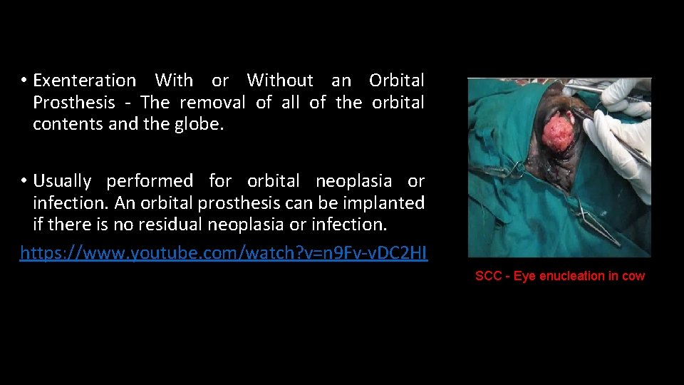  • Exenteration With or Without an Orbital Prosthesis - The removal of all