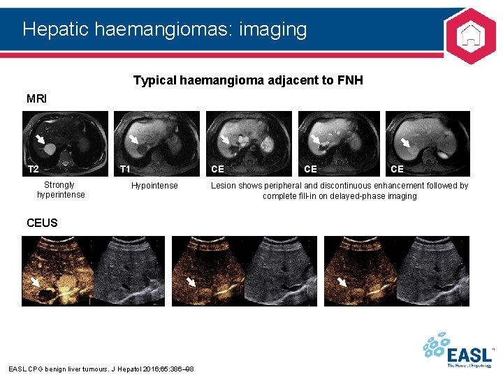 Hepatic haemangiomas: imaging Typical haemangioma adjacent to FNH MRI T 2 Strongly hyperintense T