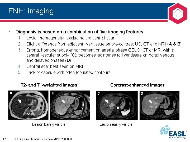 FNH: imaging • Diagnosis is based on a combination of five imaging features: 1.