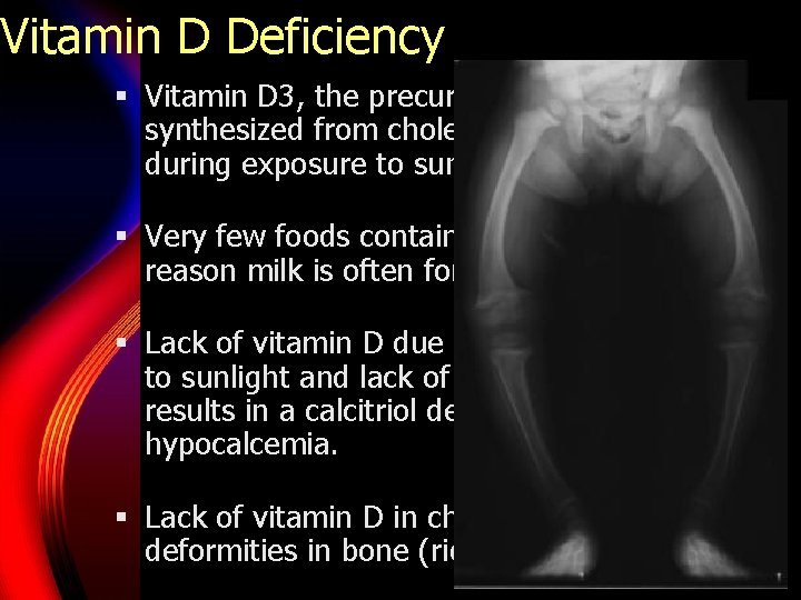 Vitamin D Deficiency § Vitamin D 3, the precursor for calcitriol, is synthesized from