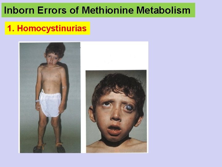 Inborn Errors of Methionine Metabolism 1. Homocystinurias 