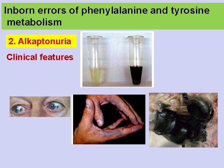 Inborn errors of phenylalanine and tyrosine metabolism 2. Alkaptonuria Clinical features 