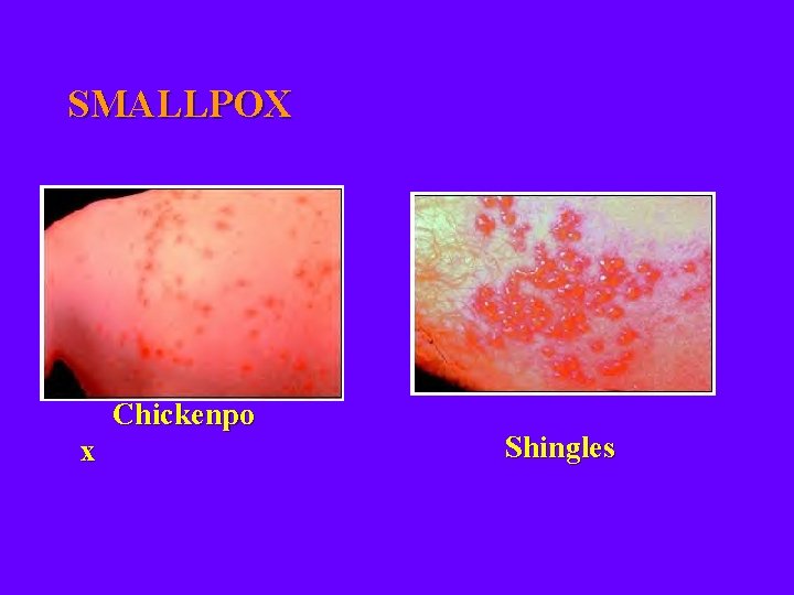 SMALLPOX Chickenpo x Shingles 