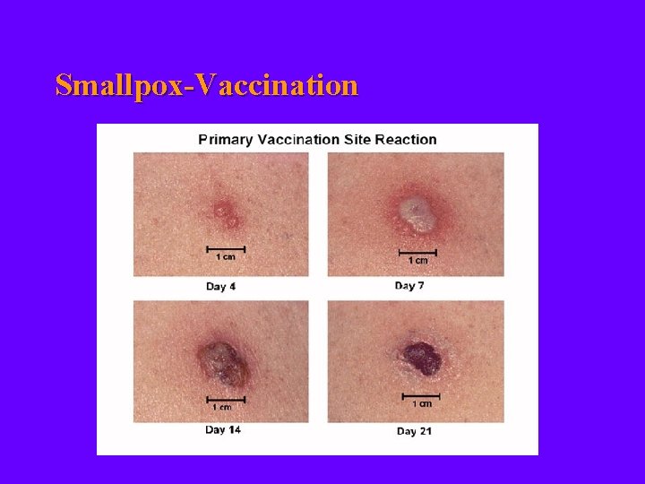 Smallpox-Vaccination 