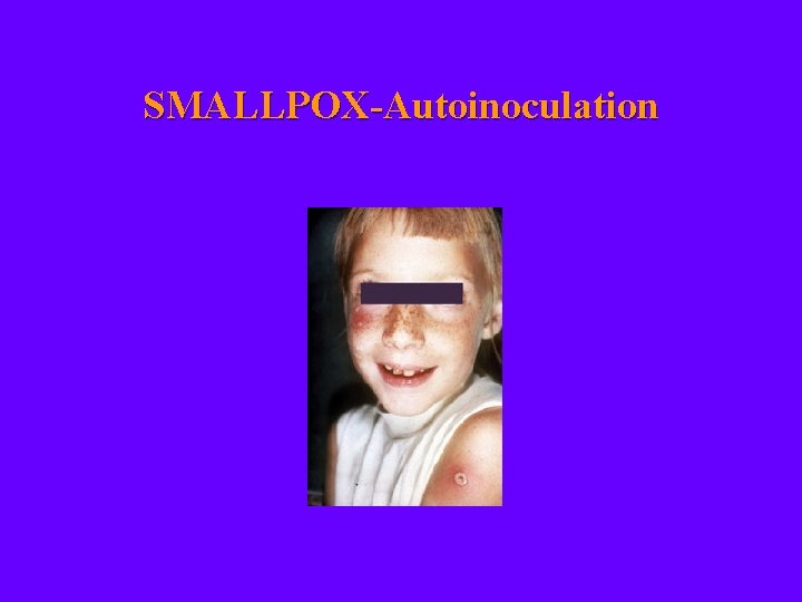 SMALLPOX-Autoinoculation 