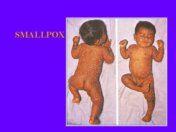 SMALLPOX 