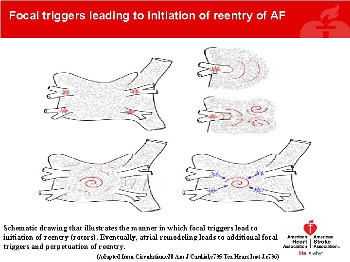 Focal triggers leading to initiation of reentry of AF Schematic drawing that illustrates the Focal triggers leading to initiation of reentry of AF Schematic drawing that illustrates the