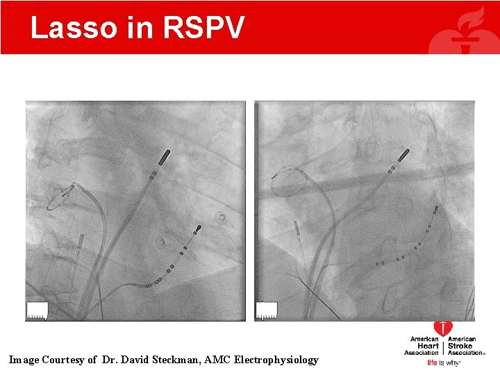 Lasso in RSPV RAO LAO Image Courtesy of Dr. David Steckman, AMC Electrophysiology Lasso in RSPV RAO LAO Image Courtesy of Dr. David Steckman, AMC Electrophysiology