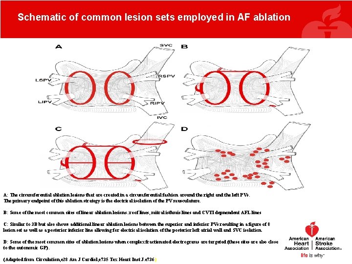 Schematic of common lesion sets employed in AF ablation A: The circumferential ablation lesions Schematic of common lesion sets employed in AF ablation A: The circumferential ablation lesions
