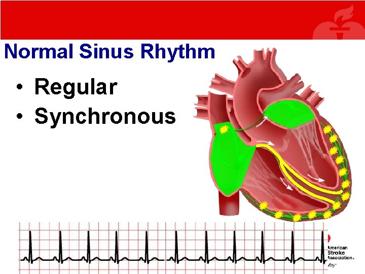 Normal Sinus Rhythm • Regular • Synchronous Normal Sinus Rhythm • Regular • Synchronous