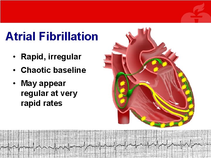 Atrial Fibrillation • Rapid, irregular • Chaotic baseline • May appear regular at very Atrial Fibrillation • Rapid, irregular • Chaotic baseline • May appear regular at very