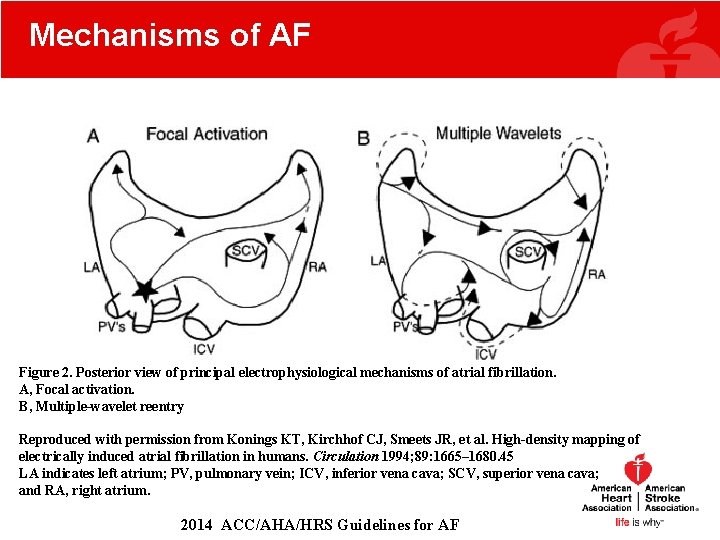 Mechanisms of AF Figure 2. Posterior view of principal electrophysiological mechanisms of atrial fibrillation. Mechanisms of AF Figure 2. Posterior view of principal electrophysiological mechanisms of atrial fibrillation.