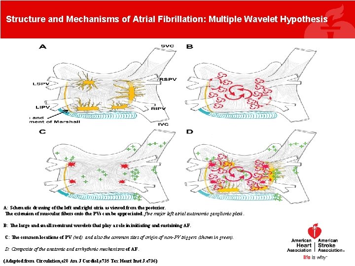 Structure and Mechanisms of Atrial Fibrillation: Multiple Wavelet Hypothesis A: Schematic drawing of the Structure and Mechanisms of Atrial Fibrillation: Multiple Wavelet Hypothesis A: Schematic drawing of the