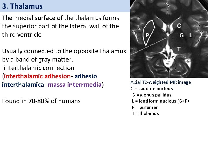 3. Thalamus The medial surface of the thalamus forms the superior part of the