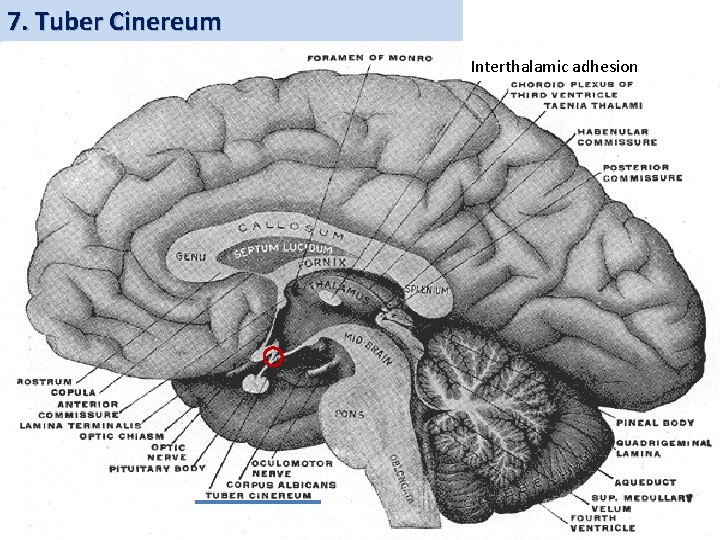 7. Tuber Cinereum Interthalamic adhesion 