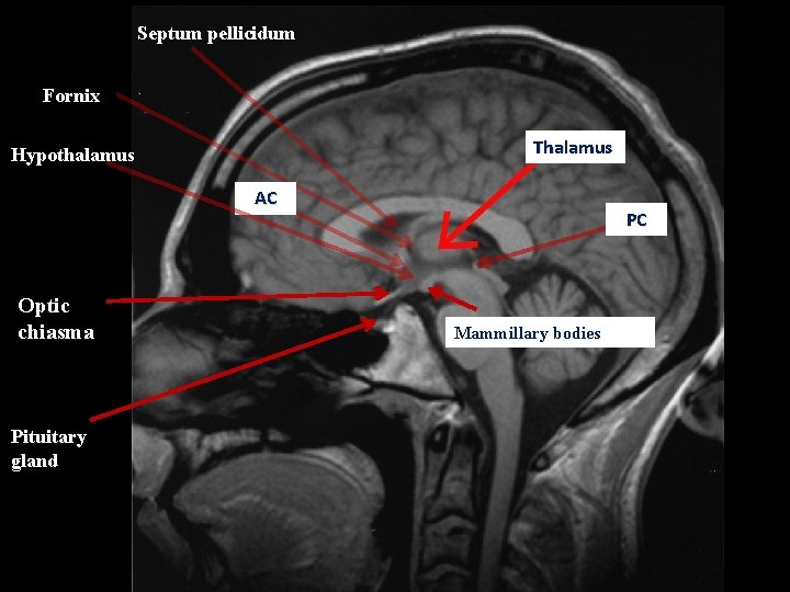 Septum pellicidum Fornix Thalamus Hypothalamus AC Optic chiasma Pituitary gland PC Mammillary bodies 