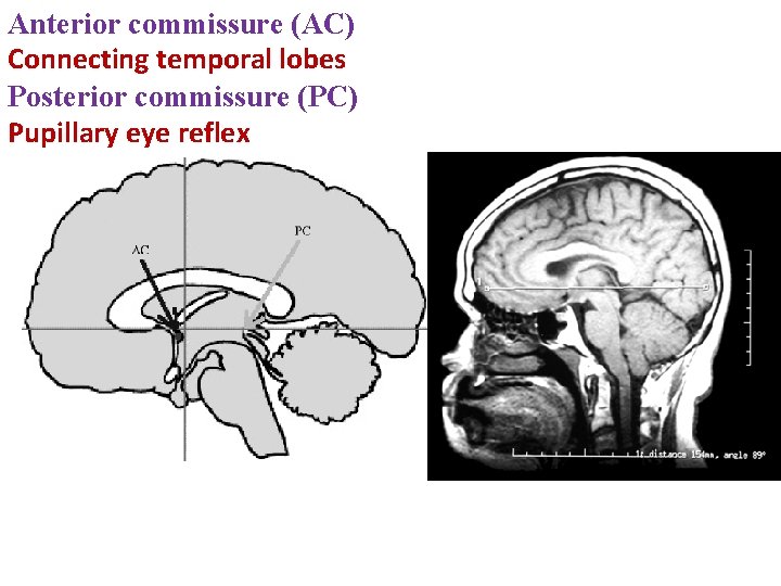 Anterior commissure (AC) Connecting temporal lobes Posterior commissure (PC) Pupillary eye reflex 