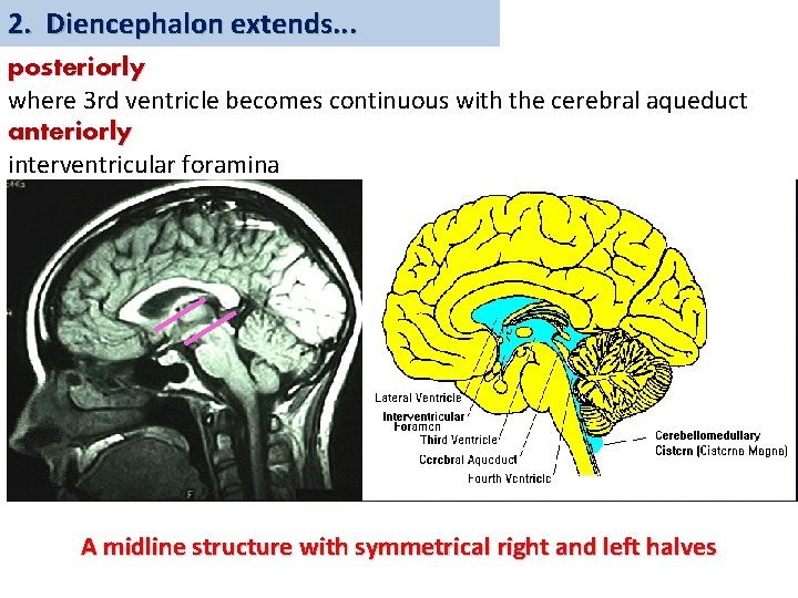 2. Diencephalon extends. . . posteriorly where 3 rd ventricle becomes continuous with the