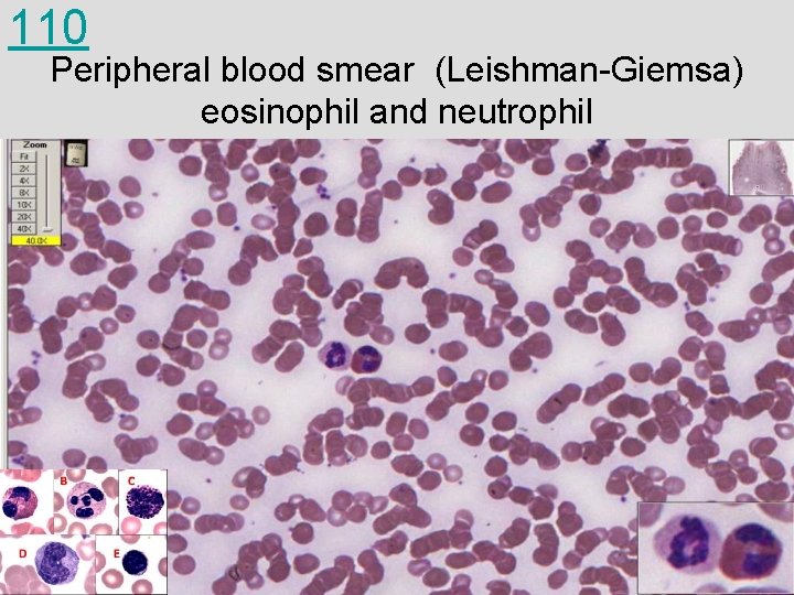 110 Peripheral blood smear (Leishman-Giemsa) eosinophil and neutrophil 