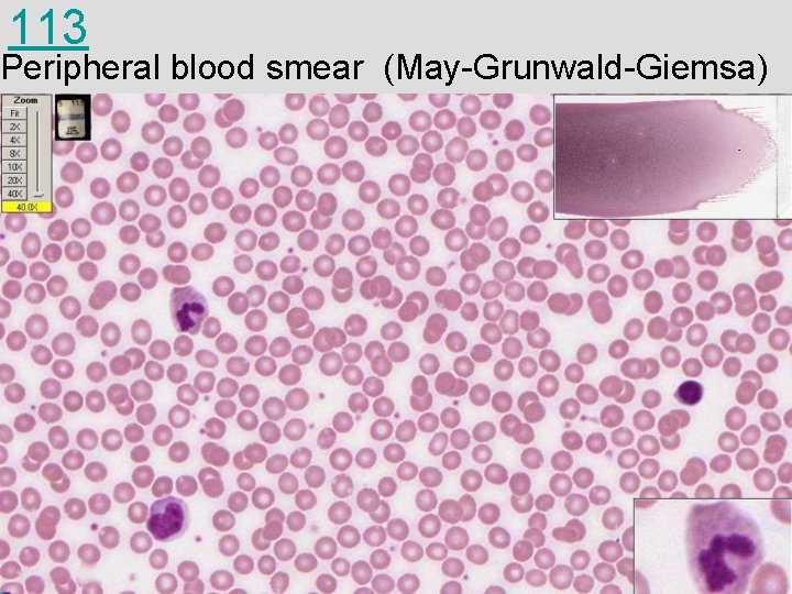 113 Peripheral blood smear (May-Grunwald-Giemsa) 