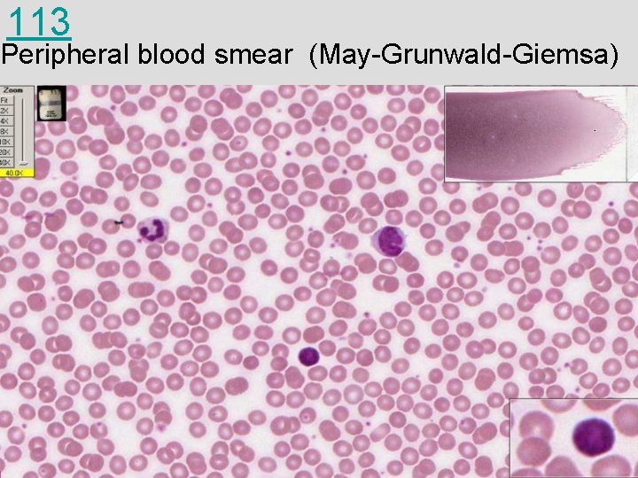 113 Peripheral blood smear (May-Grunwald-Giemsa) 