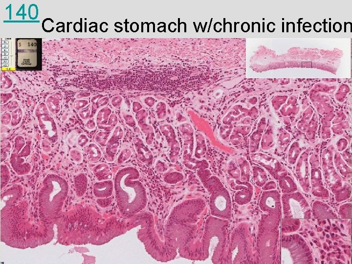 140 Cardiac stomach w/chronic infection 