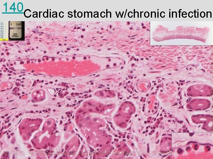 140 Cardiac stomach w/chronic infection 