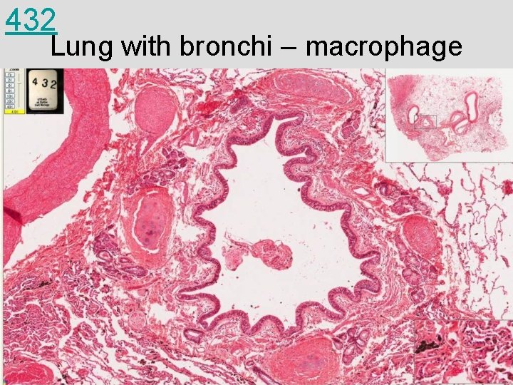 432 Lung with bronchi – macrophage 