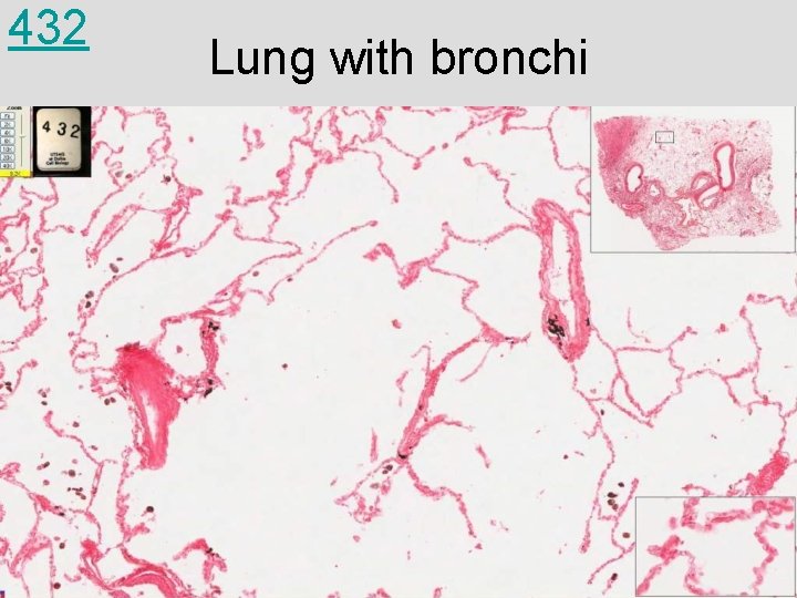 432 Lung with bronchi 