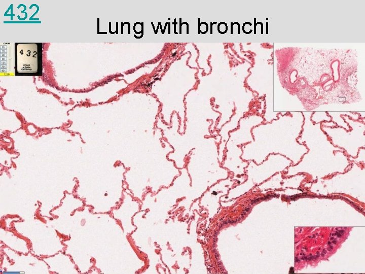 432 Lung with bronchi 