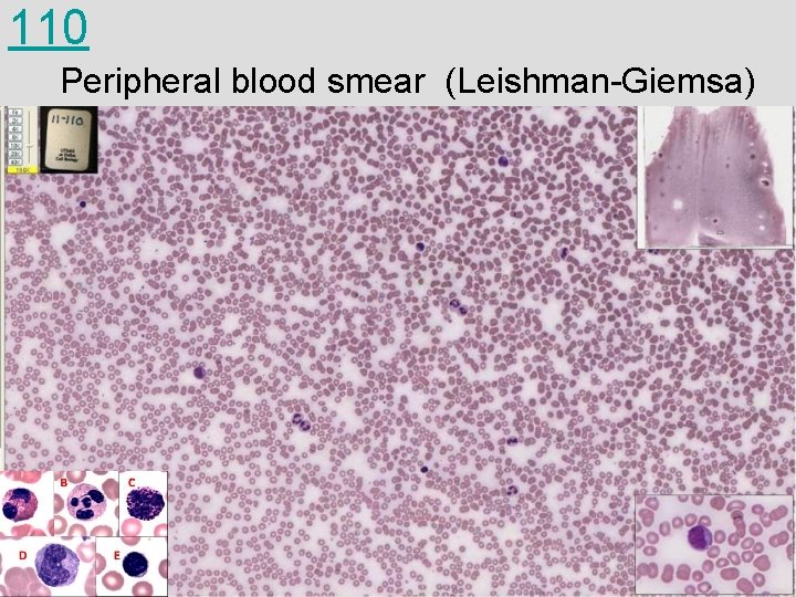 110 Peripheral blood smear (Leishman-Giemsa) 