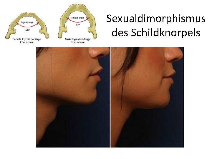Sexualdimorphismus des Schildknorpels 