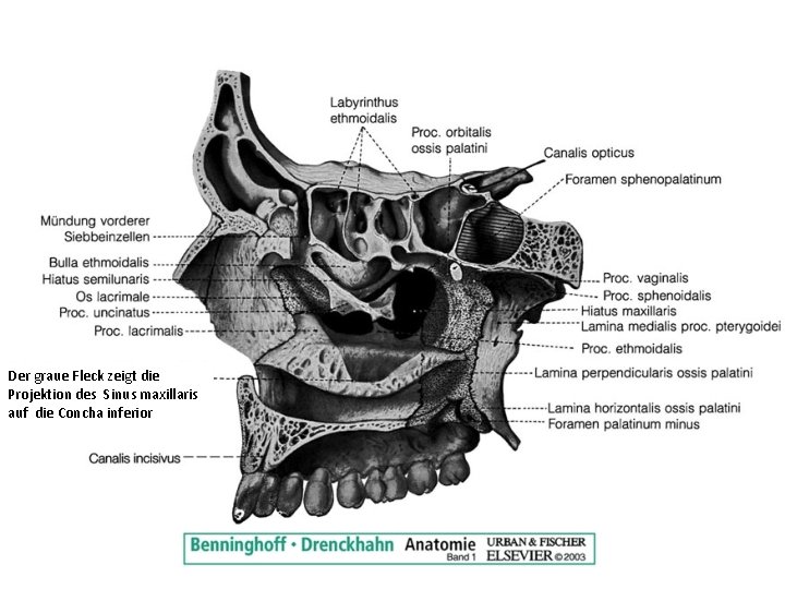 Der graue Fleck zeigt die Projektion des Sinus maxillaris auf die Concha inferior 